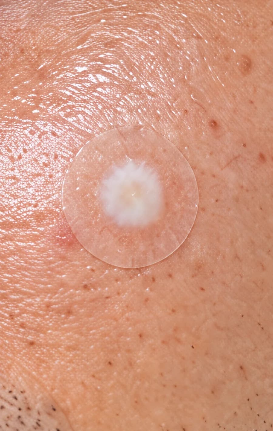 Au réveil : le même patch, blanchi au centre