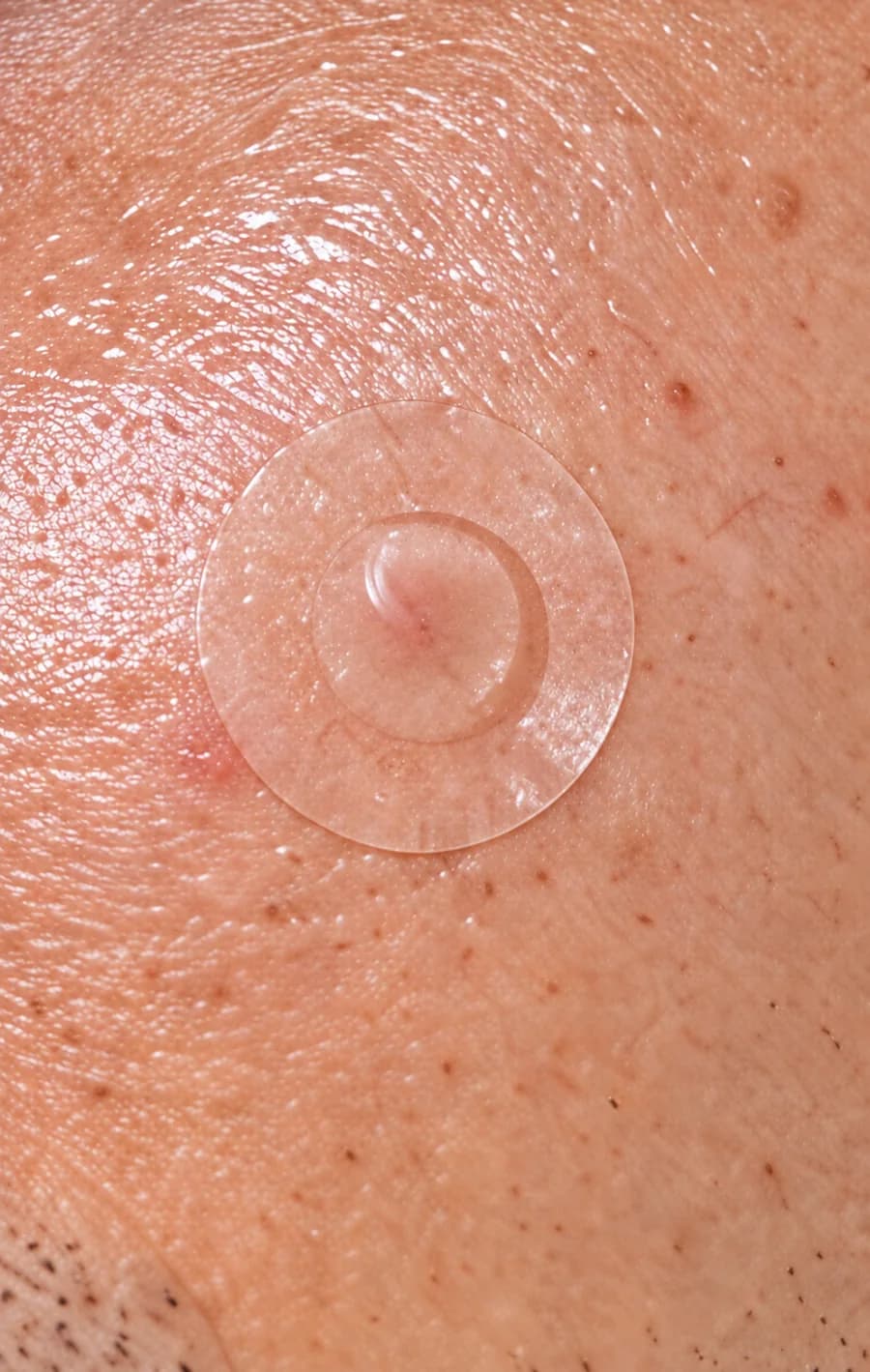 Le soir : le patch transparent posé sur le bouton